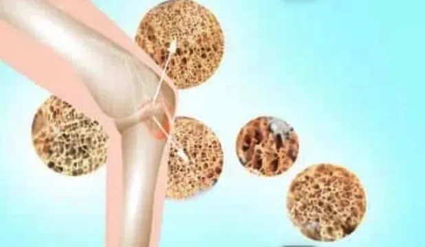 鍼灸で骨再生！三ヶ月で骨強化、年齢問わず治療効果が期待できる！