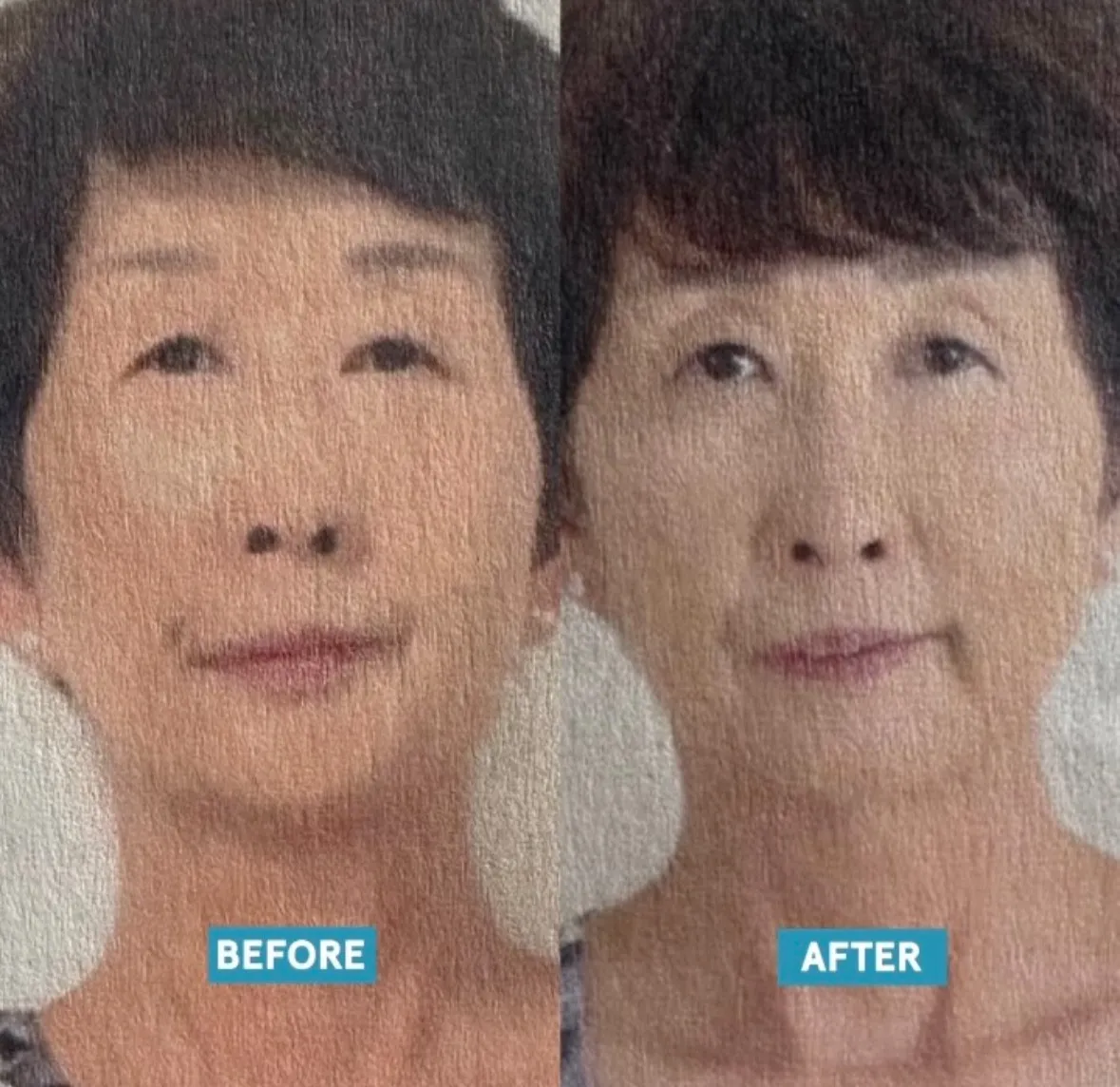 美容鍼を半年続けた６０代女性の素晴らしい変化