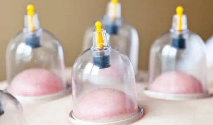 カッピング療法で疲れた体を回復！血流改善の効果とは？