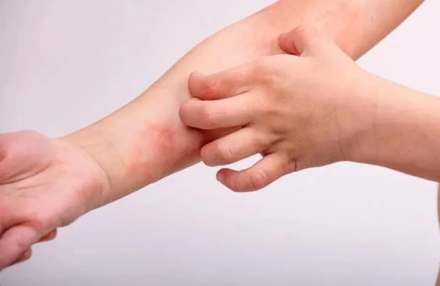 【鍼灸で緩和】アトピー性皮膚炎の痒みに効果的な肌対策